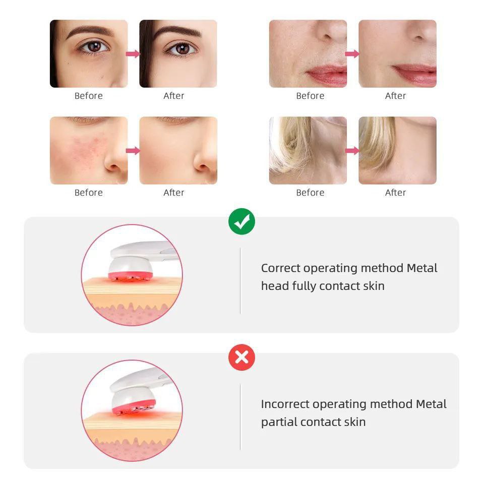 Radiofrecuencia facial portátil